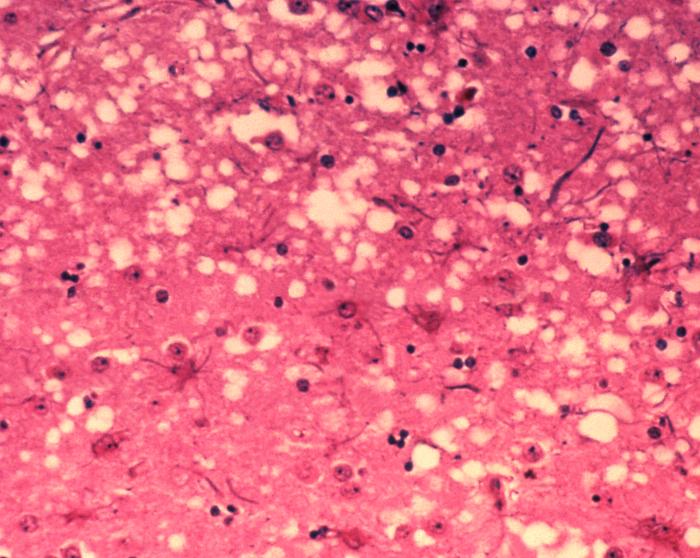 Micrografía de tejido cerebral afectado por espongiforme bovino.